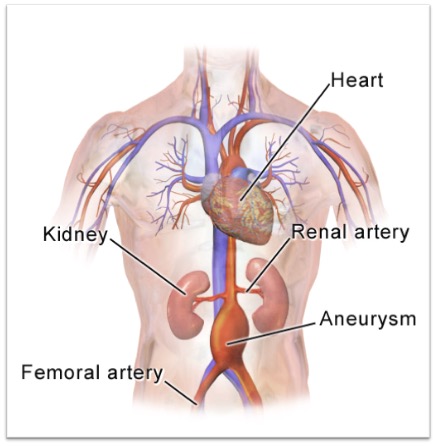 Drawing of the aorta and associated anatomy, showing an aneurysm