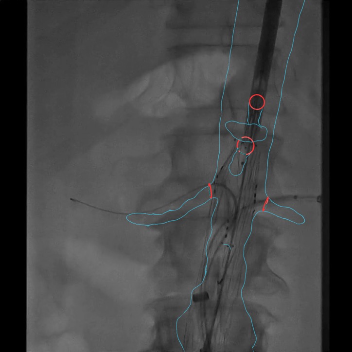 Example fluoroscopy image with Cydar EV overlay